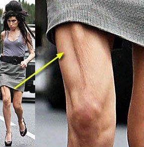 amy winehouse anoressica