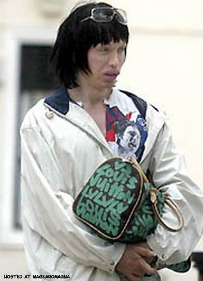 pete burns dopo l'operazione